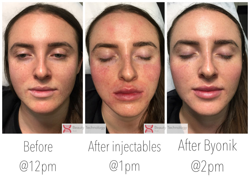 Don’t want Botox? My laser No-filler, filler facial could be just as good.