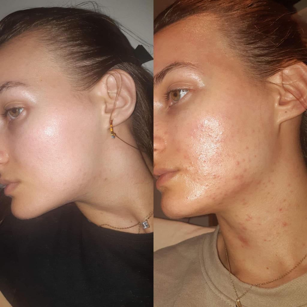 A Kinder Approach to Acne Treatment: Why I Avoid Conventional Methods ...