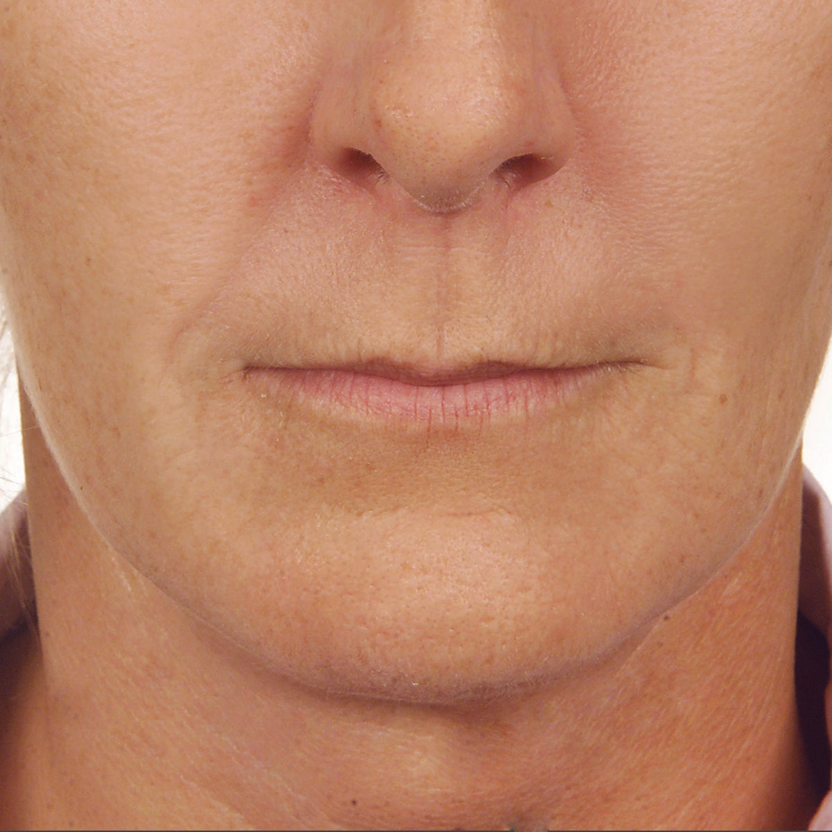 No Filler Filler Facial