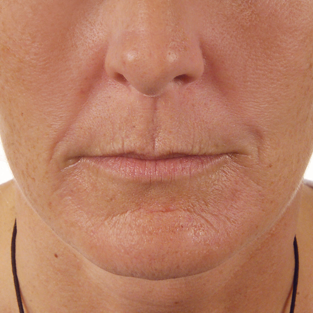 No Filler Filler Facial