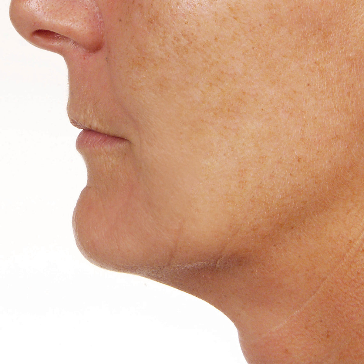 No Filler Filler Facial
