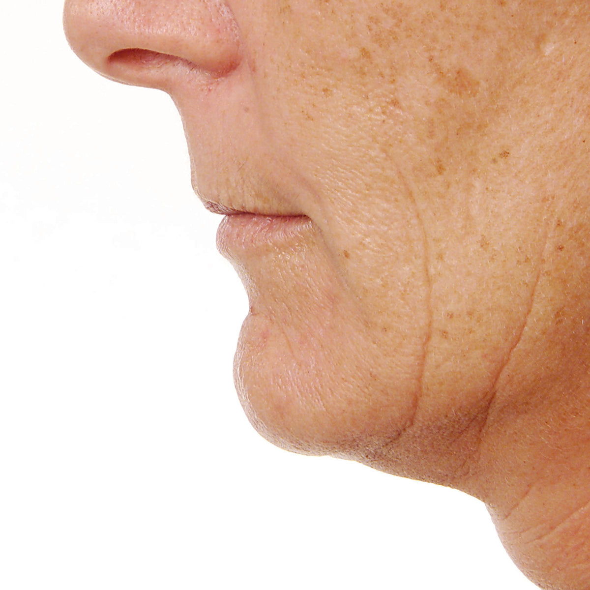 No Filler Filler Facial