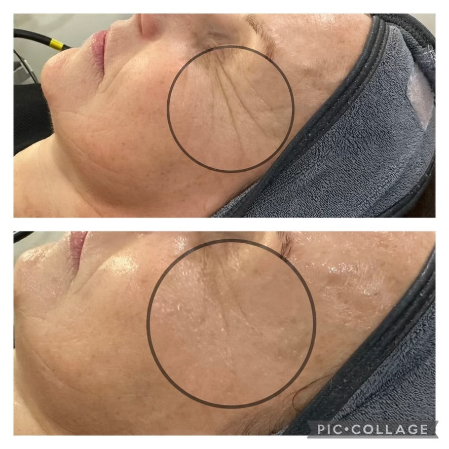 No Filler Filler Facial