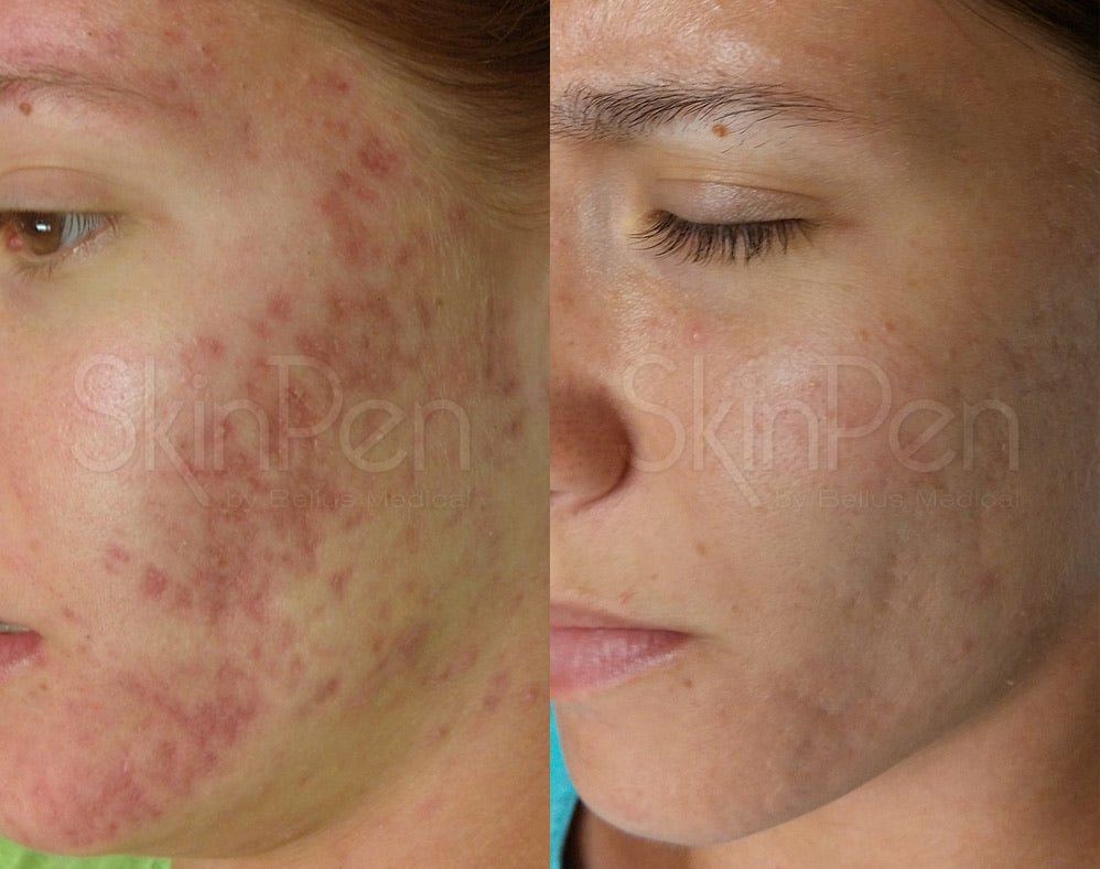 Exososome Microneedling Microinfusion + Laser