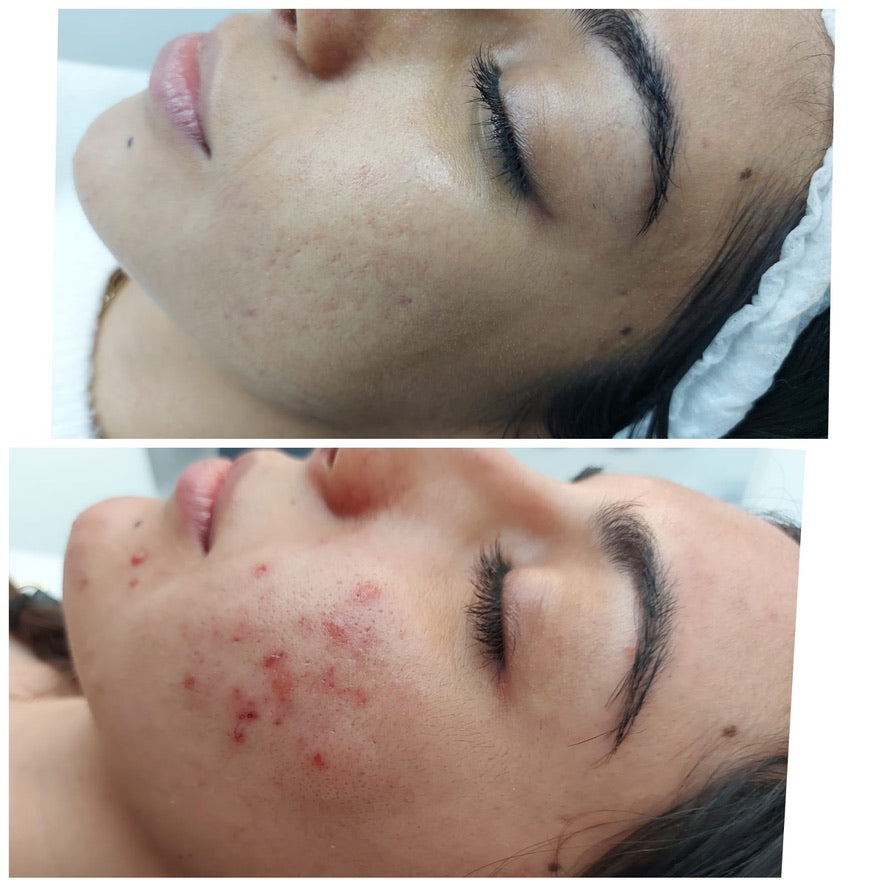 Just Cold laser (Post injectable swelling. Cystic acne. Upset/broken skin. Pre/Post holiday)