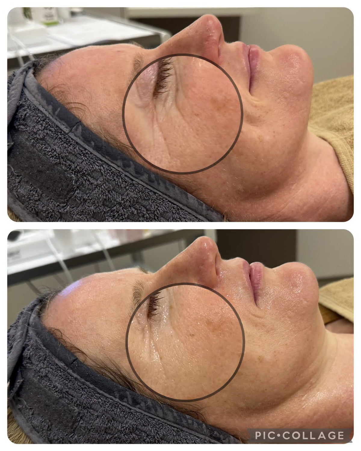 No Filler Filler Facial