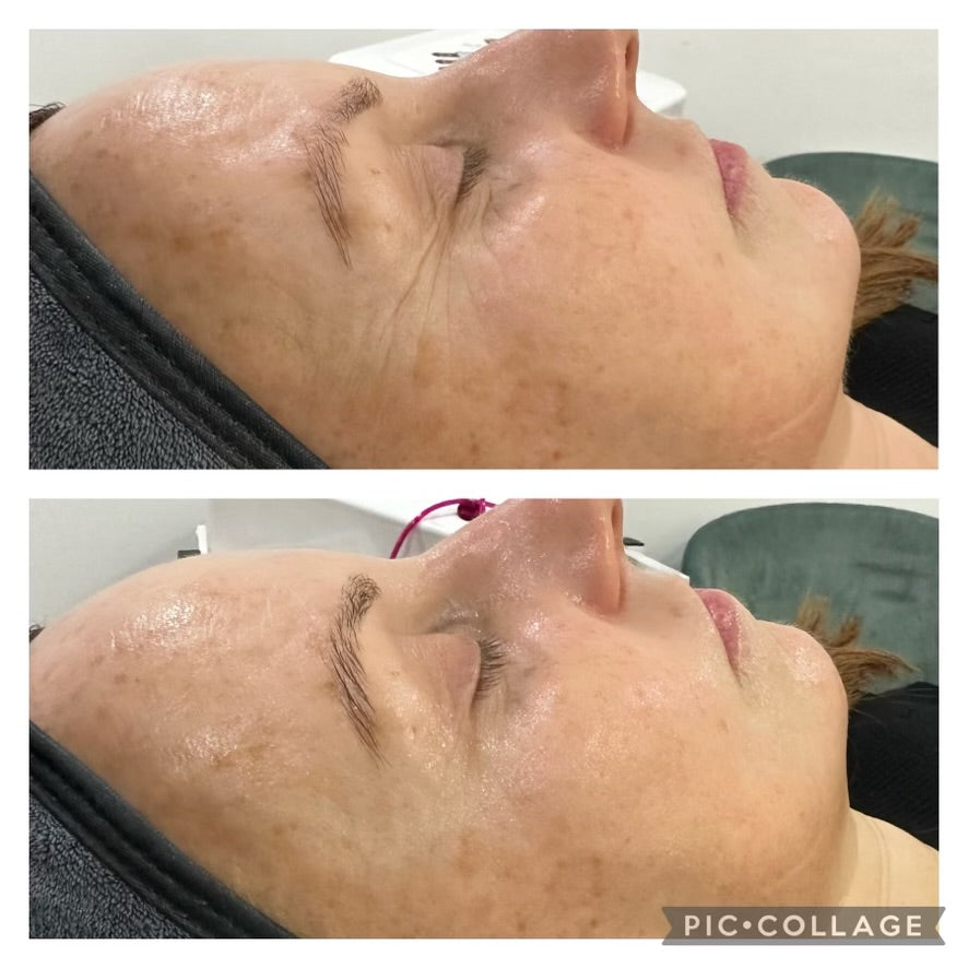 No Filler Filler Facial