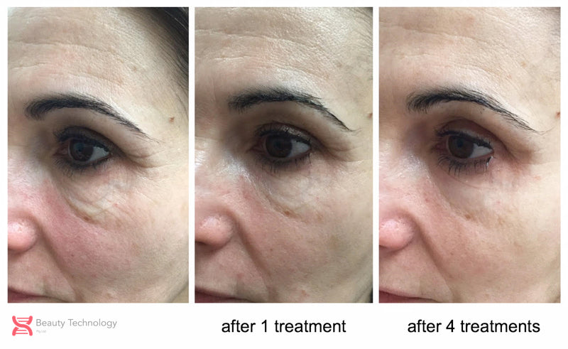 close-up-byonic-eye-boost-treatment