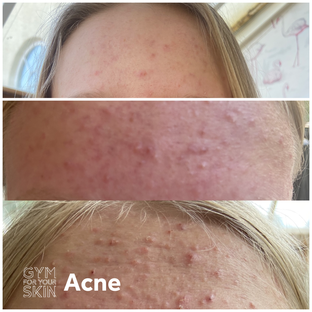 Acne Hang Up (14-22 years)