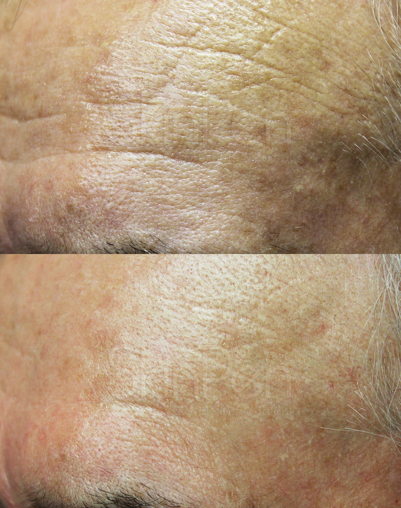 Exososome Microneedling Microinfusion + Laser