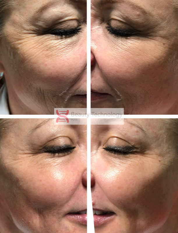 Byonik Eye Peel & Collagen Add-On