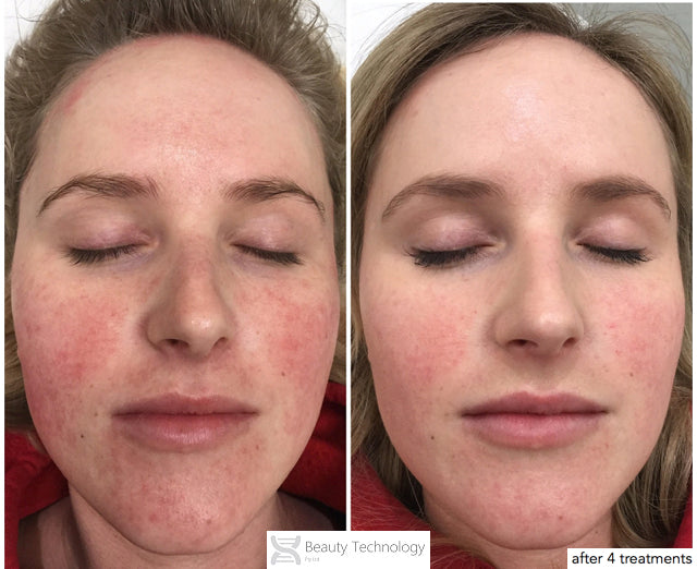 close-up-byonic-face-intensive-repair