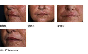 before-and-after-scar-needling-treatments