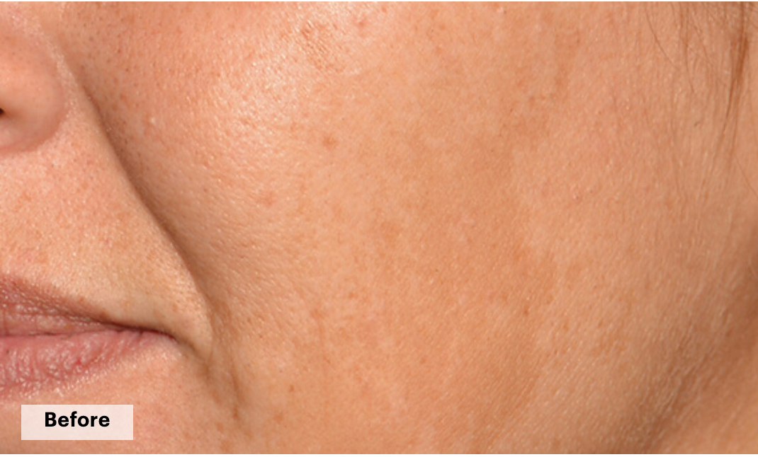 De-pigmentation series (No Peel Peel + Microneedling + Laser)