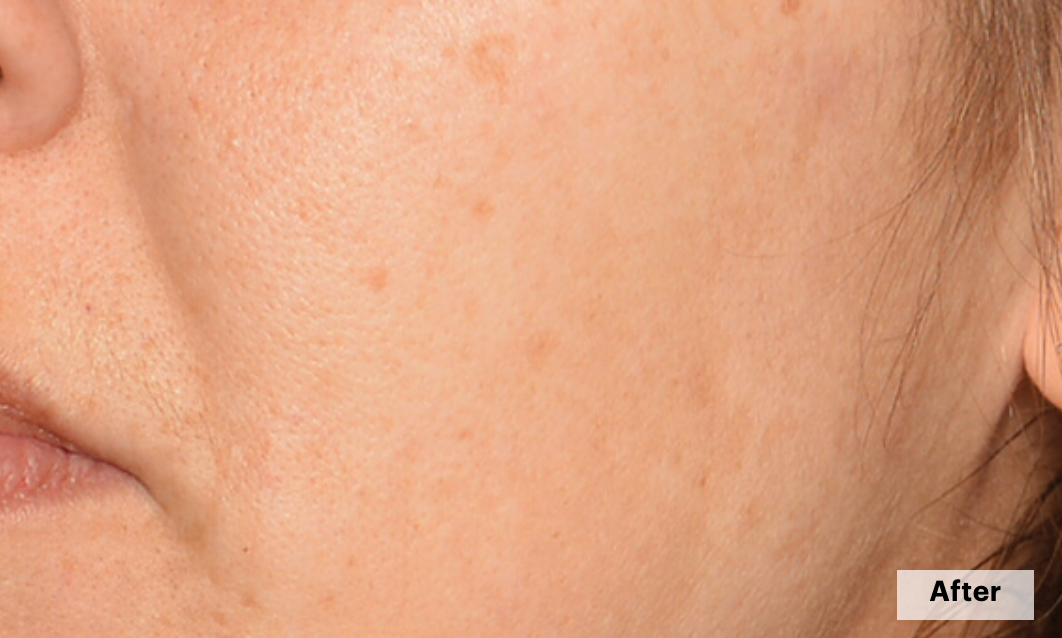 De-pigmentation series (No Peel Peel + Microneedling + Laser)