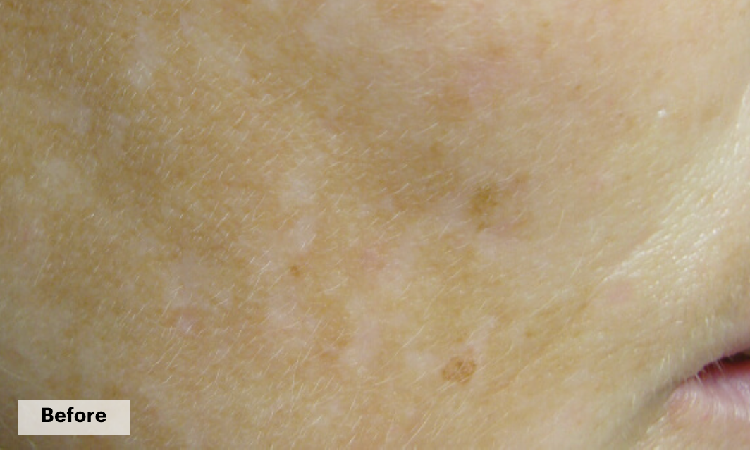 De-pigmentation series (No Peel Peel + Microneedling + Laser)