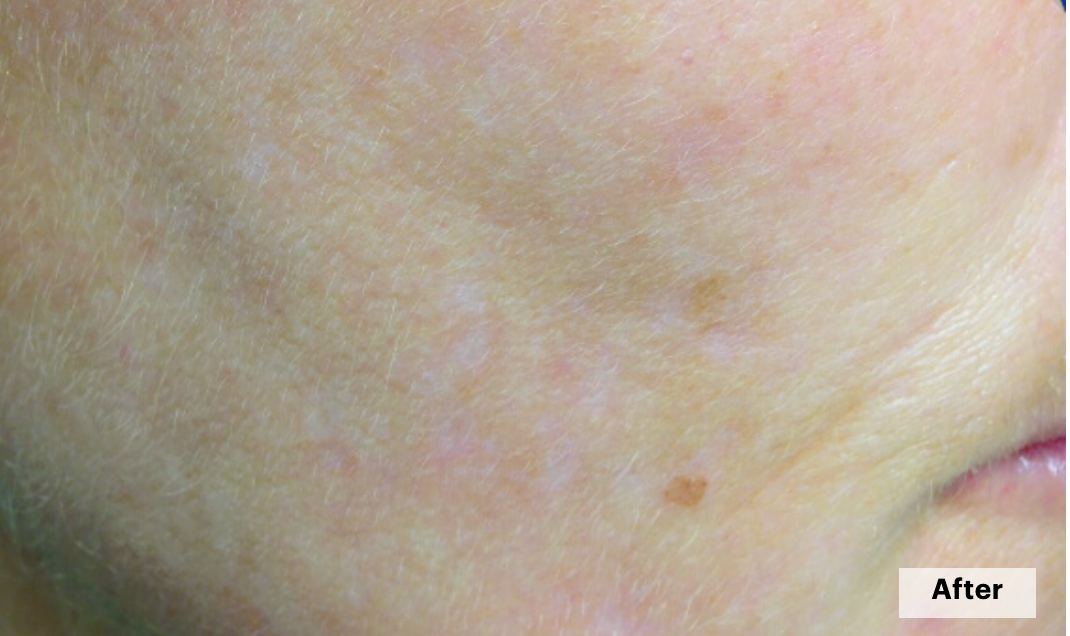 De-pigmentation series (No Peel Peel + Microneedling + Laser)