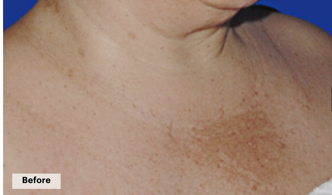 De-pigmentation series (No Peel Peel + Microneedling + Laser)