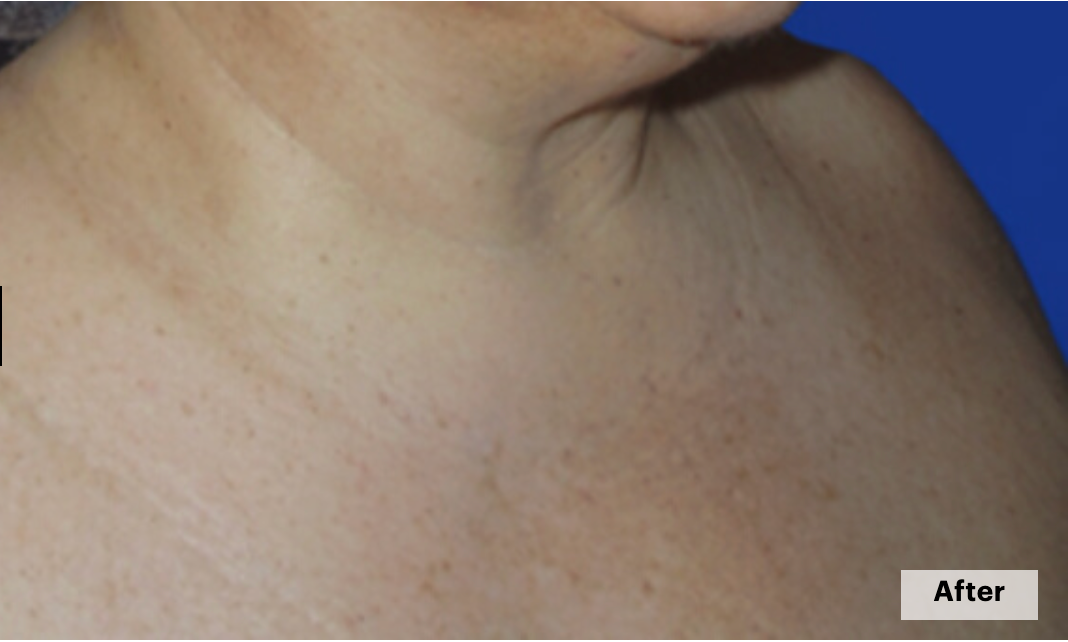 De-pigmentation series (No Peel Peel + Microneedling + Laser)