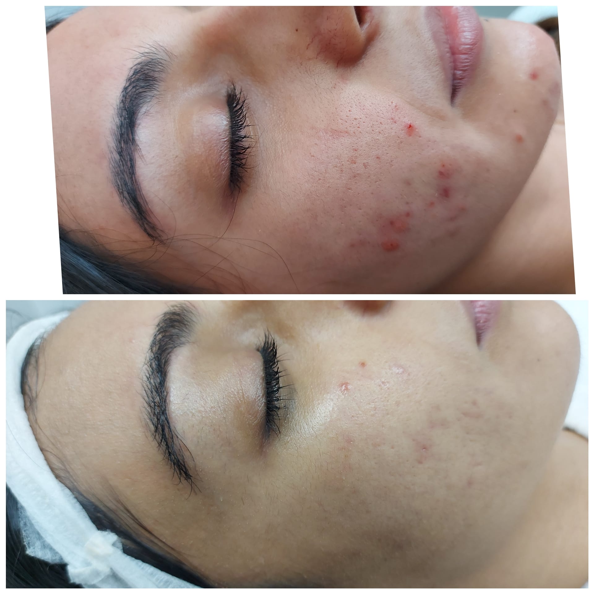 The Best Facial for Adult Acne & Rosacea